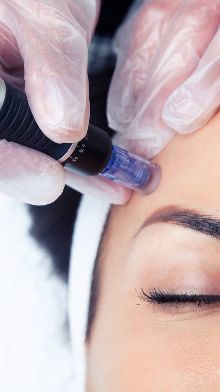 Microneedling & BioRePeel – professionelle Gesichtsbehandlung – Skin & Laser